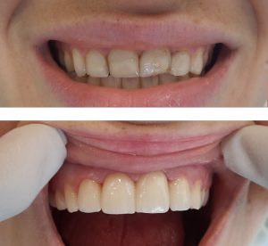 Facettes dentaires dès 80 CHF/mois